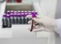 Special Complete Blood Count (CBC)